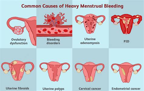 Heavy Periods Dr Nitu Bajekal