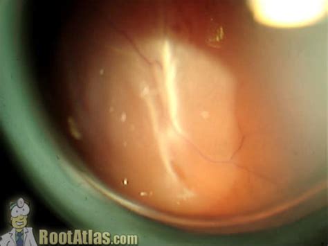 Retinal Detachment Viewed From The Slitlamp Video