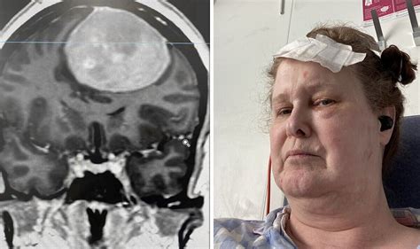 Brain Tumour Symptoms Could Include Seizures Woman Mistook The Sign For Stress Uk