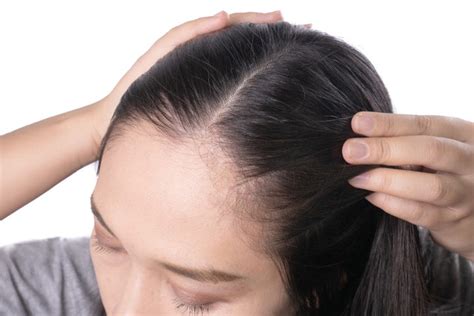 Scalp Acne Symptoms Causes And Remedies Saturn By Ghc