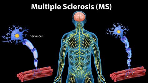 Early Signs And Symptoms Of Multiple Sclerosis Doctor Asky