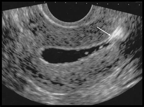 Longitudinal View Of A Normal Endometrial Cavity Outlined With Gel One Download Scientific