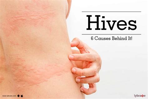 Hives Rash Or Urticuria Cause Behind Skin Disorder By Kaya Skin