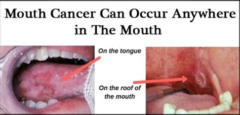 Oral Cancer Dr Kanishk Mehta Udaipur