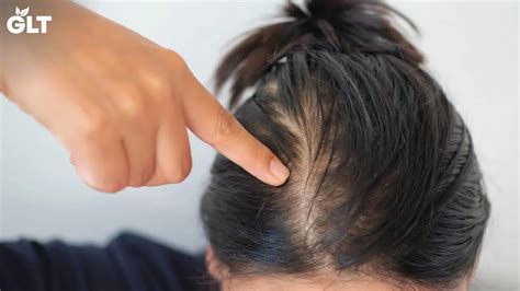 5 most common reasons for hair fall in women and how to solve it youtube