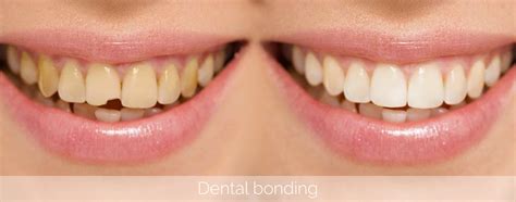 Why Dental Bonding? - KIMIA FAMILY DENTISTRY