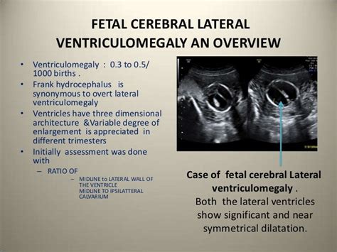 Congenital Lateral Ventriculomegaly Fetal Neuro Camden Maxwell