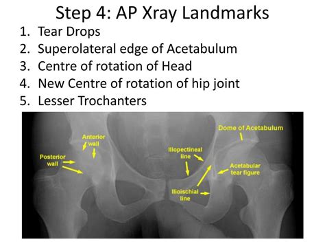 Ppt Primary Total Hip Arthroplasty Powerpoint Presentation Free