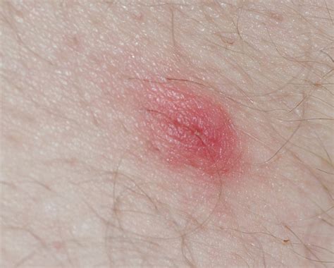 What Does A Tick Bite Look Like Health Images And Pho Vrogue Co