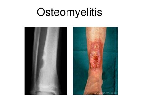Ppt Osteomyelitis Powerpoint Presentation Free Download Id4527026