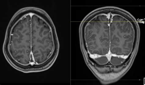 Radiology Mri Intracranial Hypotension With Dural Sinus