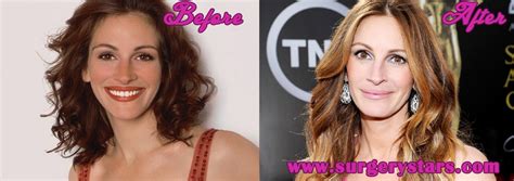 Julia Roberts Plastic Surgery Before And After Photos