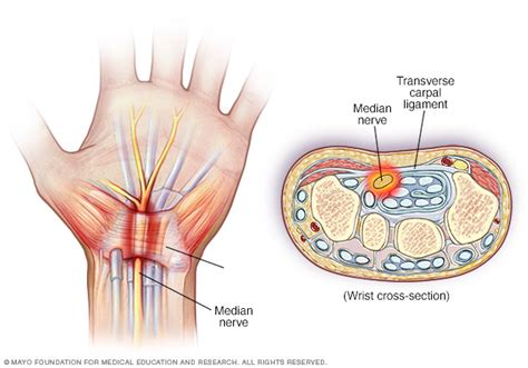 Pinched Nerve Disease Reference Guide