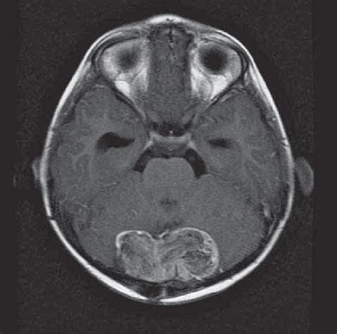 Axial T1 Wi Post Gadolinium Shows A Heterogeneous Enhancing Lesion At