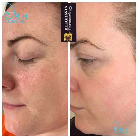 Sciton Halo Hybrid Fractional Laser Treatment Uk Dr H Consult