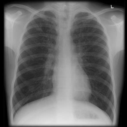 Cystic Fibrosis Pulmonary Manifestations Radiology Reference