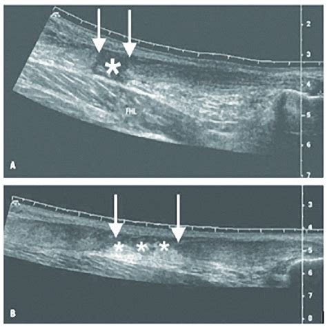 A Longitudinal Scan Image Of Complete Achilles Tendon Rupture Gap In