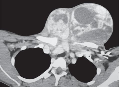 A Rare Case Of A Giant Congenital Multinodular Goiter With