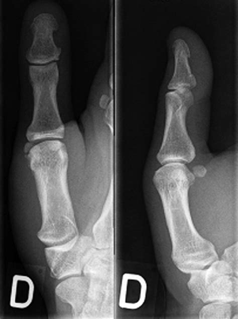 Standard A P And Lateral View Of The Thumb Showing The Fracture Of The