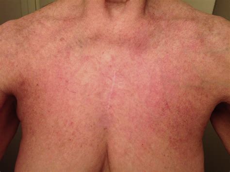 Lupus Rash On Neck And Chest