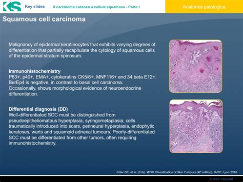 Il Carcinoma Cutaneo A Cellule Squamose