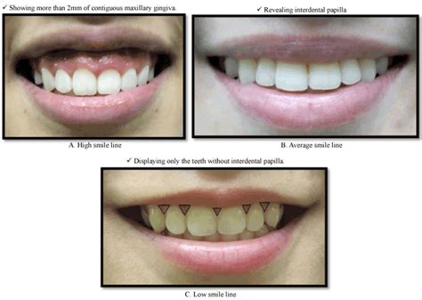 马来西亚人嘴唇长度与微笑线的关系一项横断面研究