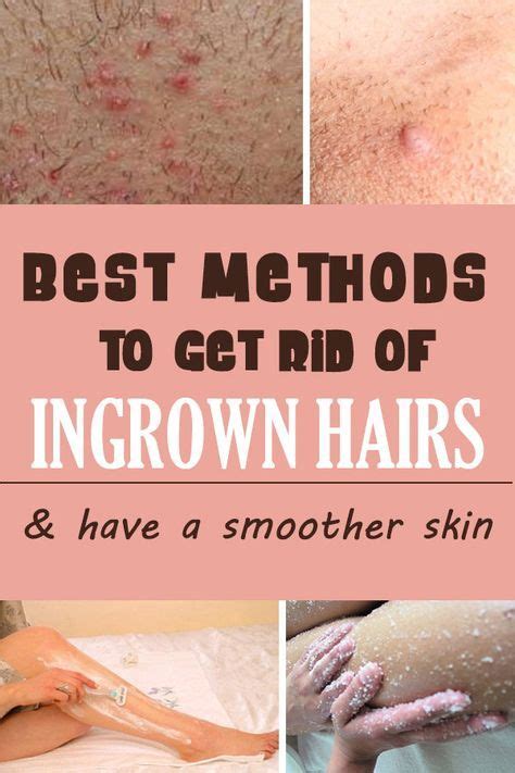 what gets rid of ingrown hairs how to get rid of ingrown hair tips for ingrown hair removal