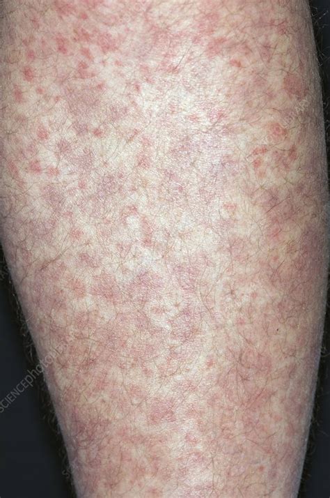 Allergic Purpura On The Leg Stock Image C0111677 Science Photo