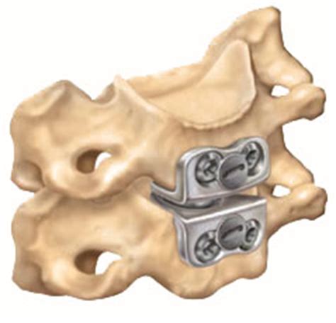 How much herniated disc surgery costs depends on the exact type of surgery being done. Cervical Disc Arthroplasty Melbourne | Neck Surgery Richmond VIC