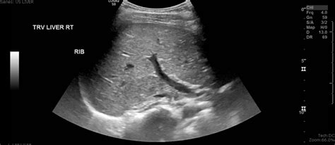 Liver Anatomy Ultrasound
