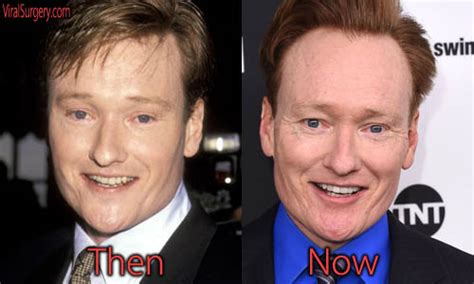 Conan Obrien Plastic Surgery Before And After Botox Pictures