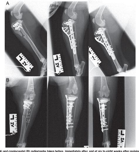Figure 2 From Treatment Of Tibial Diaphyseal Fractures Following
