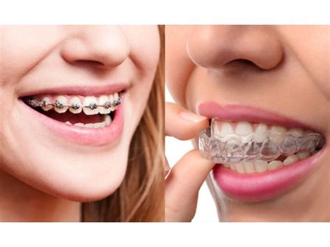 Aparelho Ortodôntico Invisalign Centro Médico de Margaride