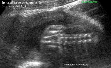 Spina Bifida Aperta Avec Petite Méningocèle échographie