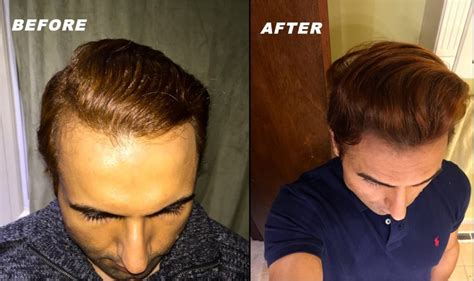 Before i hop into the technical side of minoxidil and using it on your beard, here were a few people that saw great results by beard and minoxidil application: Does Minoxidil Work for Receding Hairline? - HairstyleVill