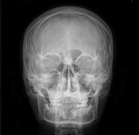 Zygomaticus Major Zygomatic Bone Angle Of Mouth