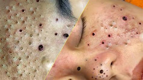 Popping Huge Blackheads And Pimple Popping Relax Every Day With Spa