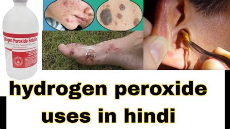Hydrogen Peroxide Uses In Hindi Hydrogen Peroxide Ear Wax Removal