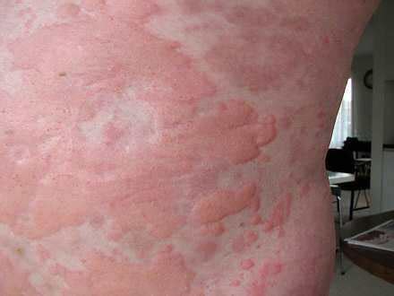 If your skin itches especially at night, you could be having either dry skin or some other underlying medical condition. What is the best treatment for hives? - Quora