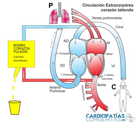 Circulación Extracorpórea La Web De Las Cardiopatías Congénitas