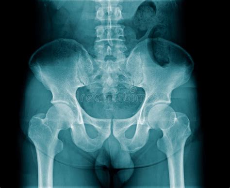 X Ray Image Pelvic Bone And Hip Joint Stock Image Image Of Pelvis