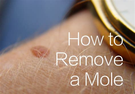 How To Use Apple Cider Vinegar To Treat Moles Hubpages