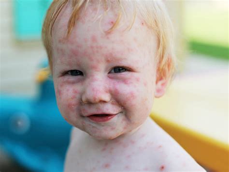My Child Developed A Rash About A Week After Receiving The Mmr Vaccine