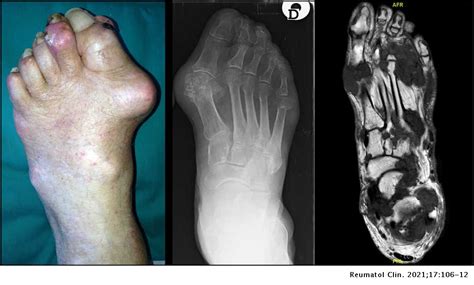 Gouty Involvement Of Foot And Ankle Beyond Flares Reumatología Clínica
