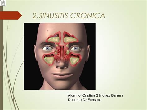 Sinusitis Cronica Cristian Sanchez Barrera Drfonseca