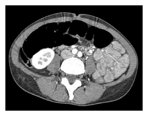 Contrast Enhanced Abdominal Computed Tomography Demonstrating Small