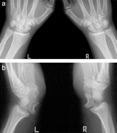 Pre Operative A Posteroanterior And B Lateral X Rays Of Both Wrists