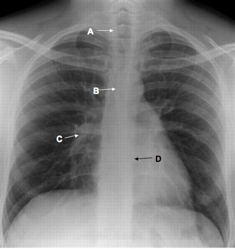 Chest Radiograph Posterior Anterior View The BMJ