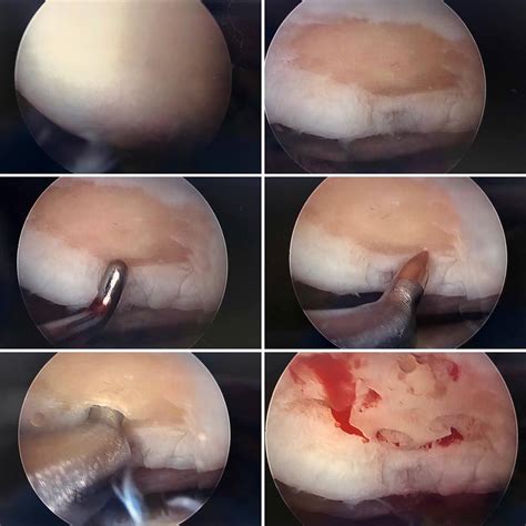 What Does Knee Arthritis Look Like In Hd Orthopaedic Specialists
