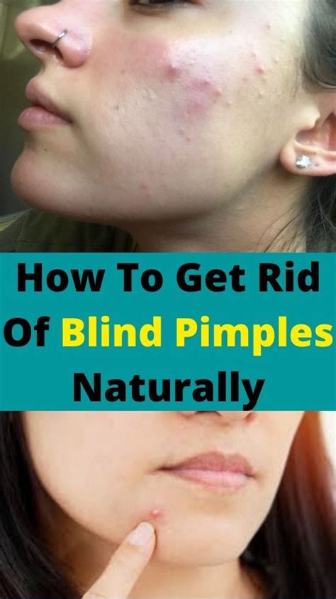 How To Get Rid Of Blind Pimples Naturally Blind Pimple